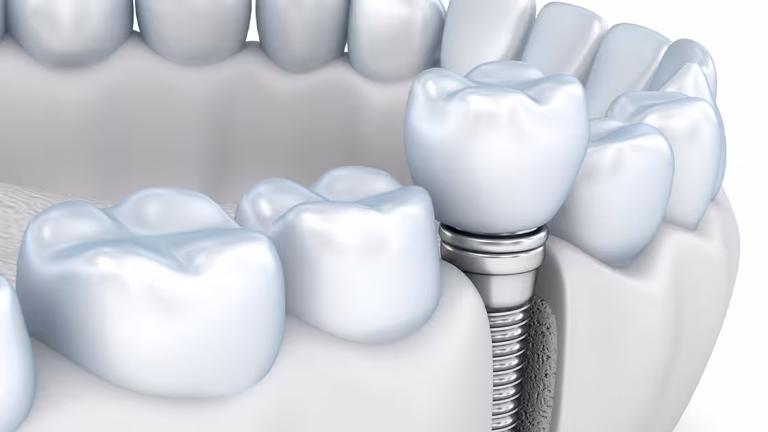 Dental implant